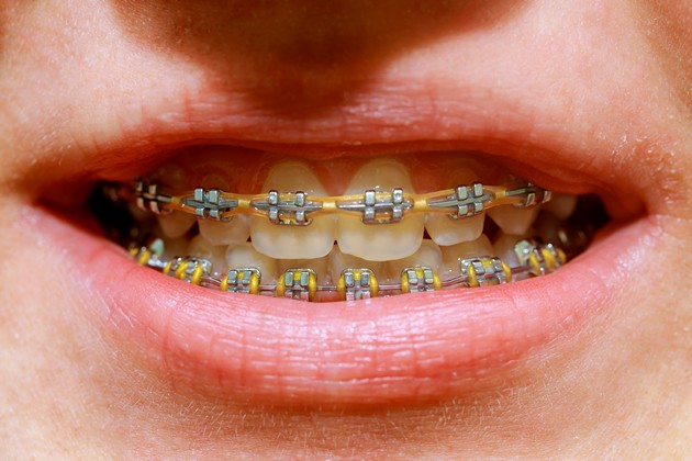.:: aparelho_ortodontico_os_diferentes_modelos_e_suas_funcoes_40204_1_pt.jpg ::.