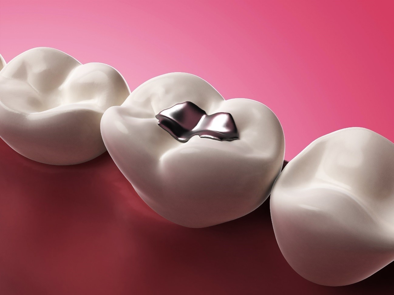 .:: restauracoes_antigas_em_amalgama_sao_prejudiciais_a_saude_e_aos_dentes_41265_1_pt.jpg ::.
