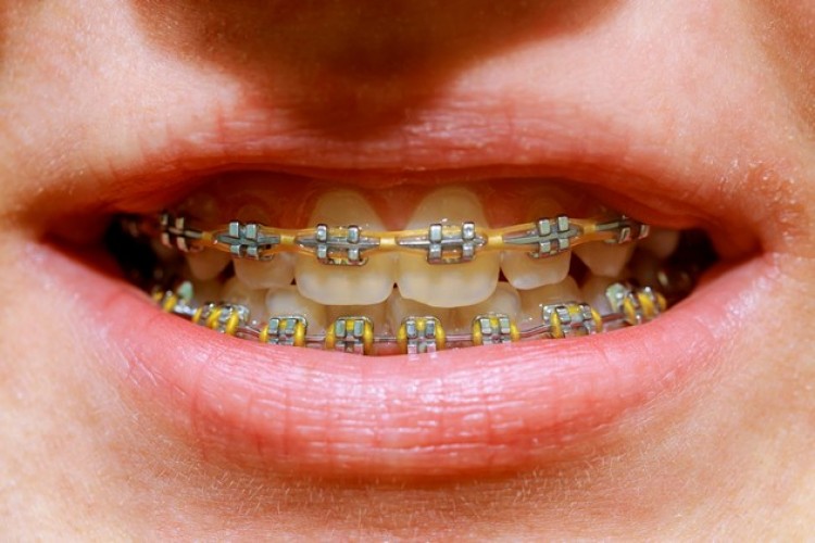 .:: aparelho_ortodontico_os_diferentes_modelos_e_suas_funcoes_40204_1_pt.jpg ::.